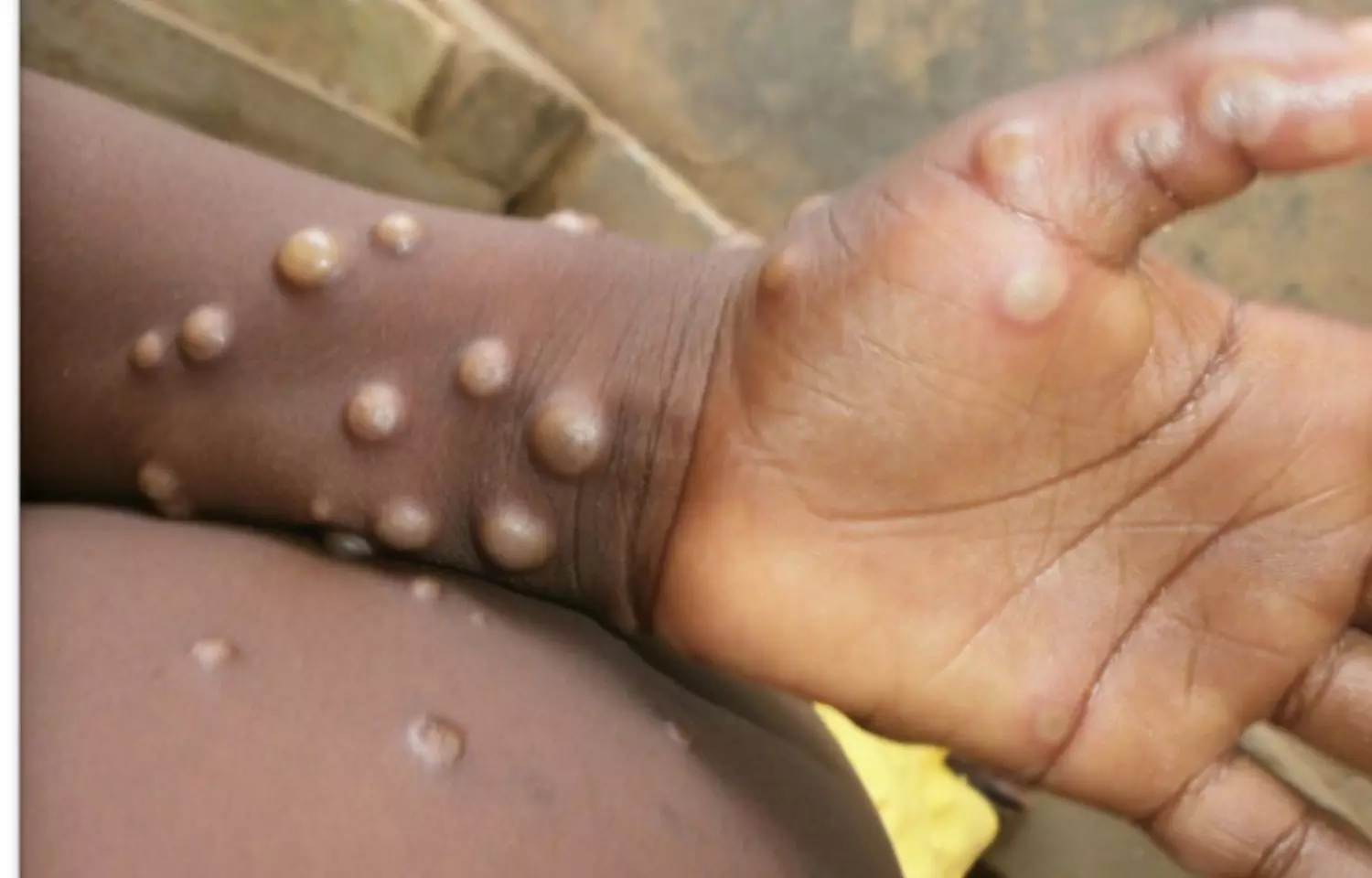 Health Ministry releases Guidelines for Monkeypox Treatment, Details