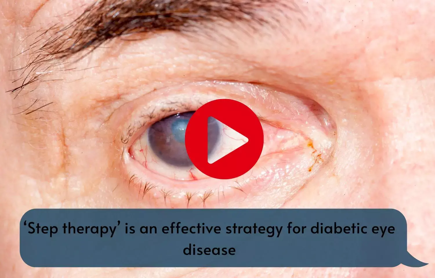Step therapy an effective strategy for diabetic eye disease