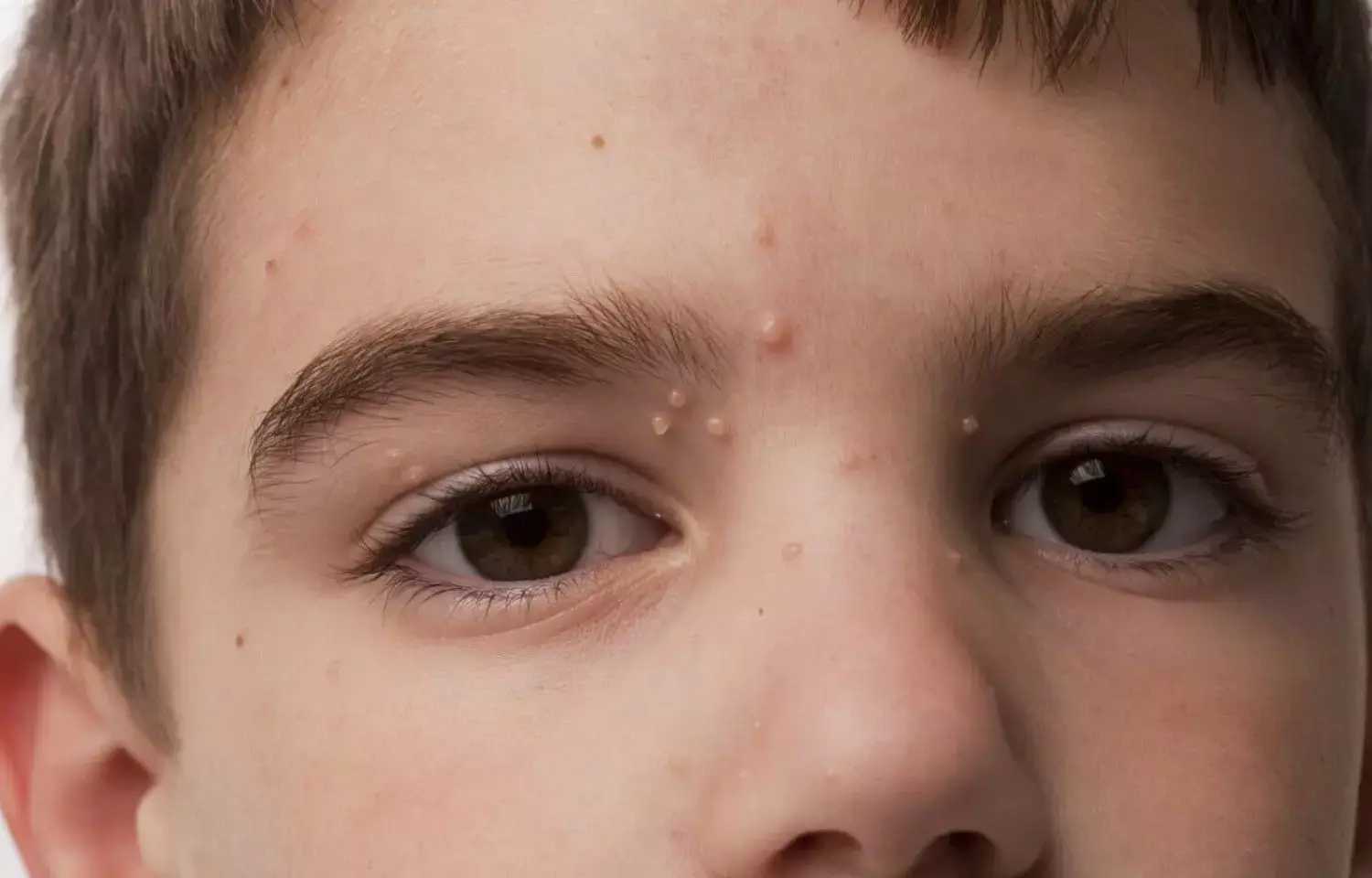 Once daily Topical berdazimer a novel approach for treating Molluscum contagiosum: JAMA
