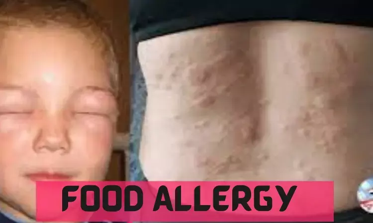 Atopy Patch Test may help identify and diagnose food allergies in Children