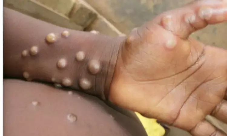Health Ministry releases Guidelines for Monkeypox Treatment, Details