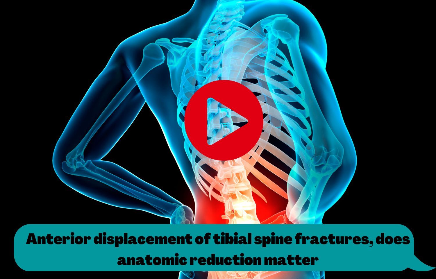 Anterior displacement of tibial spine fractures, does anatomic ...