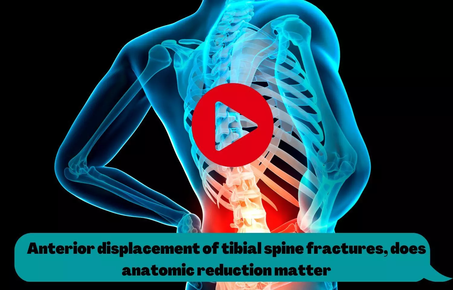 Anterior displacement of tibial spine fractures, does anatomic reduction matter