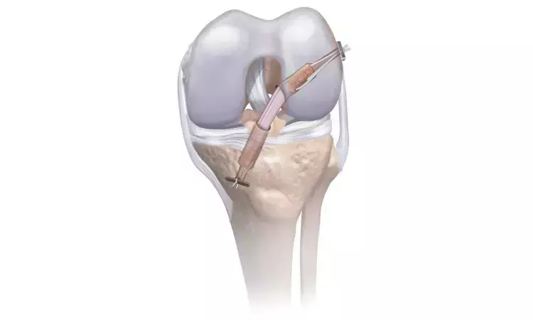 ACL repair patients have better outcomes than patients who undergo ACL reconstruction