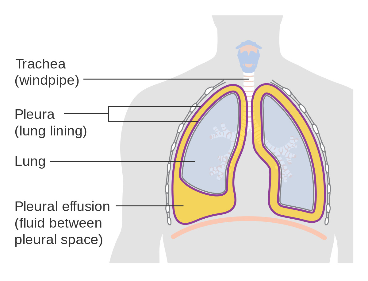 Intrapleural fibrinolytic and enzyme therapy confers low overall ...