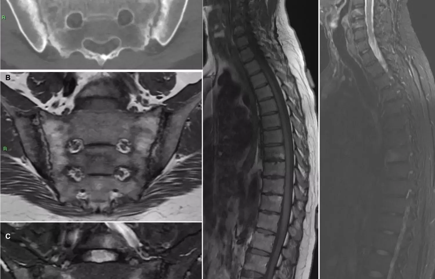 Findings on spine MRI may not always indicate spondyloarthritis: Study
