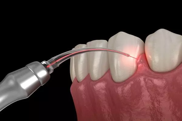 Laser therapy good option for the management of alveolar osteitis