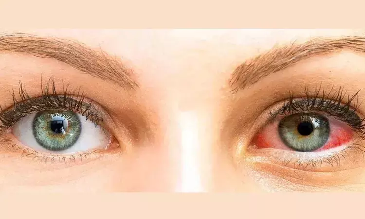 Water-Free Cyclosporine Solution may Improve Dry Eye Disease symptoms: JAMA