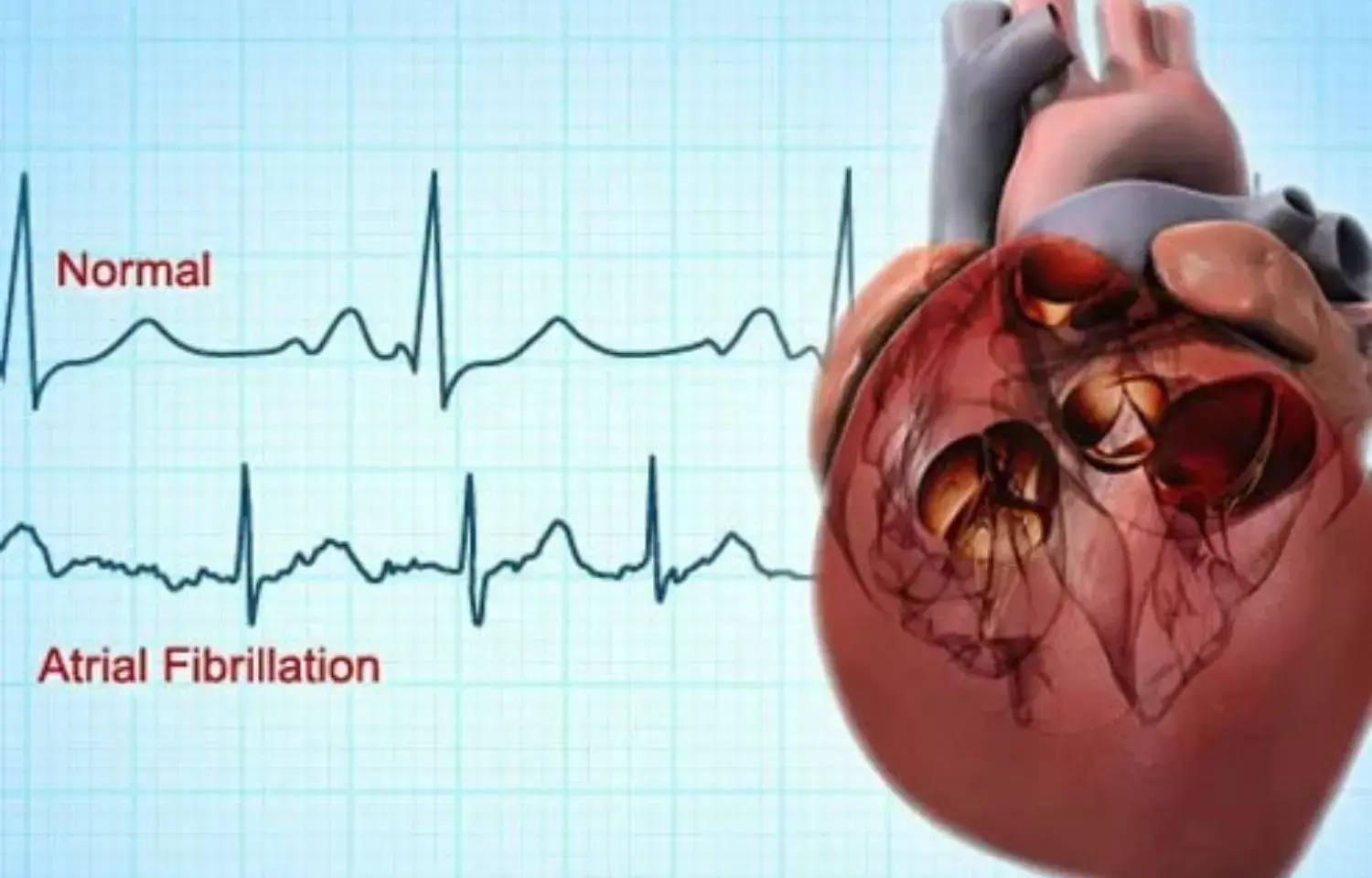 Subclinical atrial fibrillation  common in patients with cardiac IEDs: Study