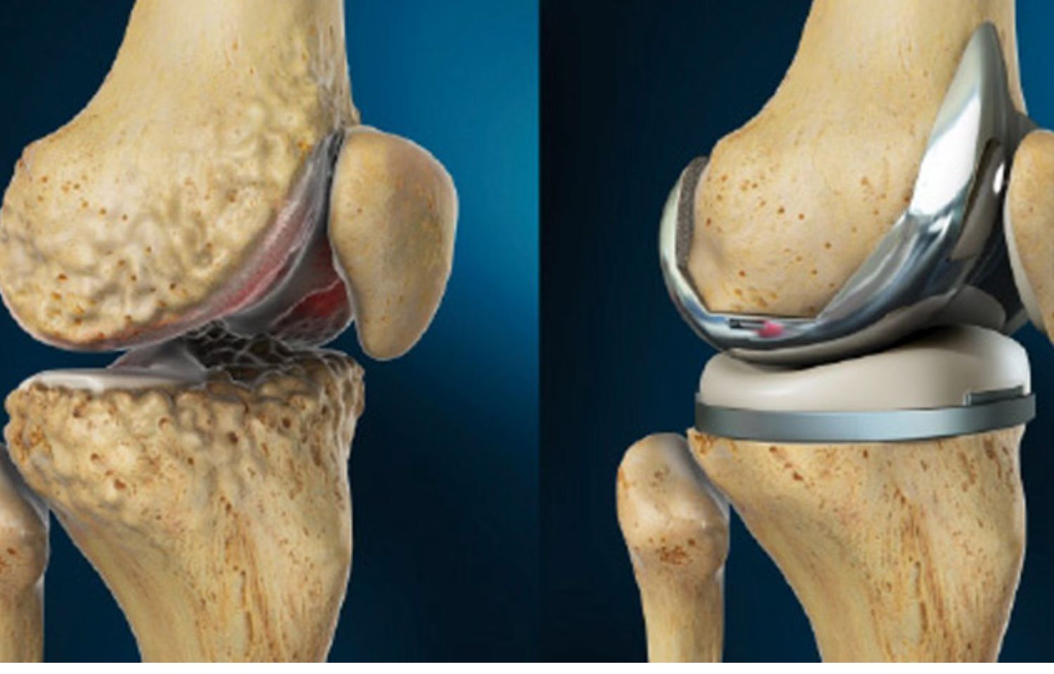 Эндопротез коленного сустава