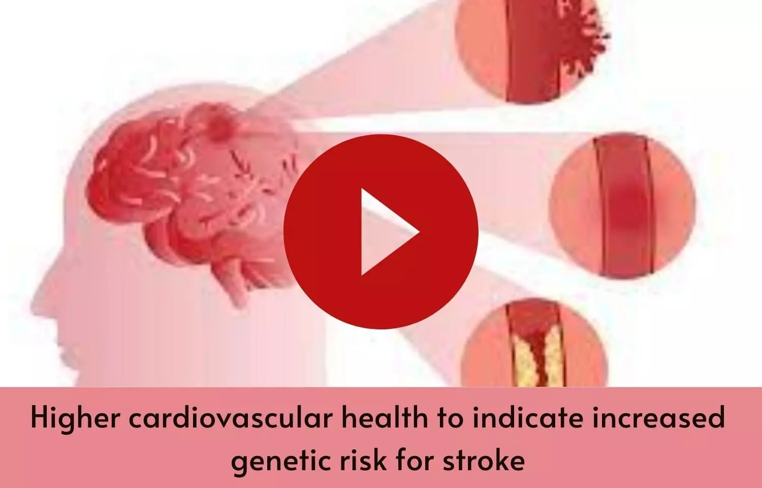Higher cardiovascular health to indicate increased genetic risk for stroke