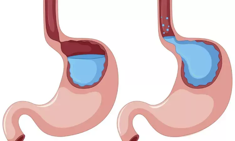 Transoral Incisionless Fundoplication effective in reducing gastroesophageal reflux disease symptoms