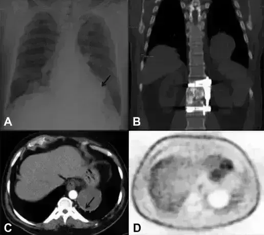 Rare case of Intrathoracic gossypiboma presenting 47 years later as a purulent fistula: A report