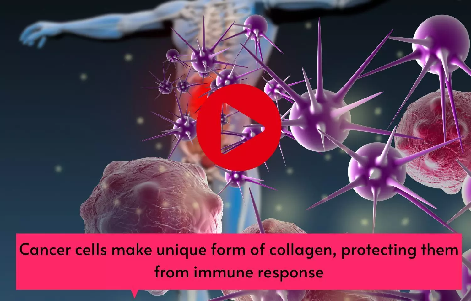 Cancer cells make unique form of collagen, protecting them from immune response