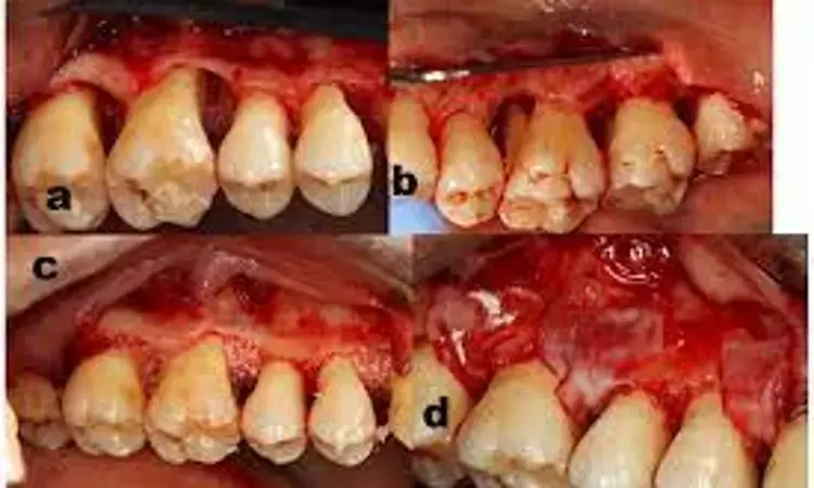 Stem cells in tissue engineering beneficial for regeneration of periodontal defects