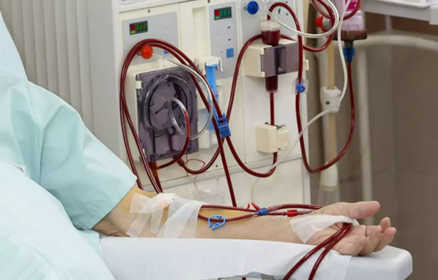Dialysis leads to impaired cardiovascular functional capacity in CKD patients: JAHA