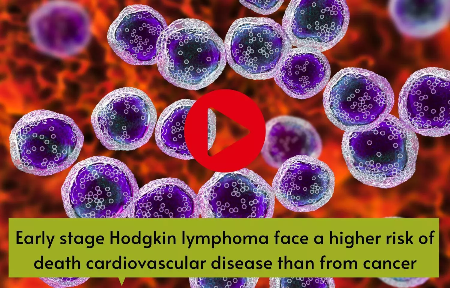Early stage Hodgkin lymphoma face a higher risk of death cardiovascular disease than from cancer