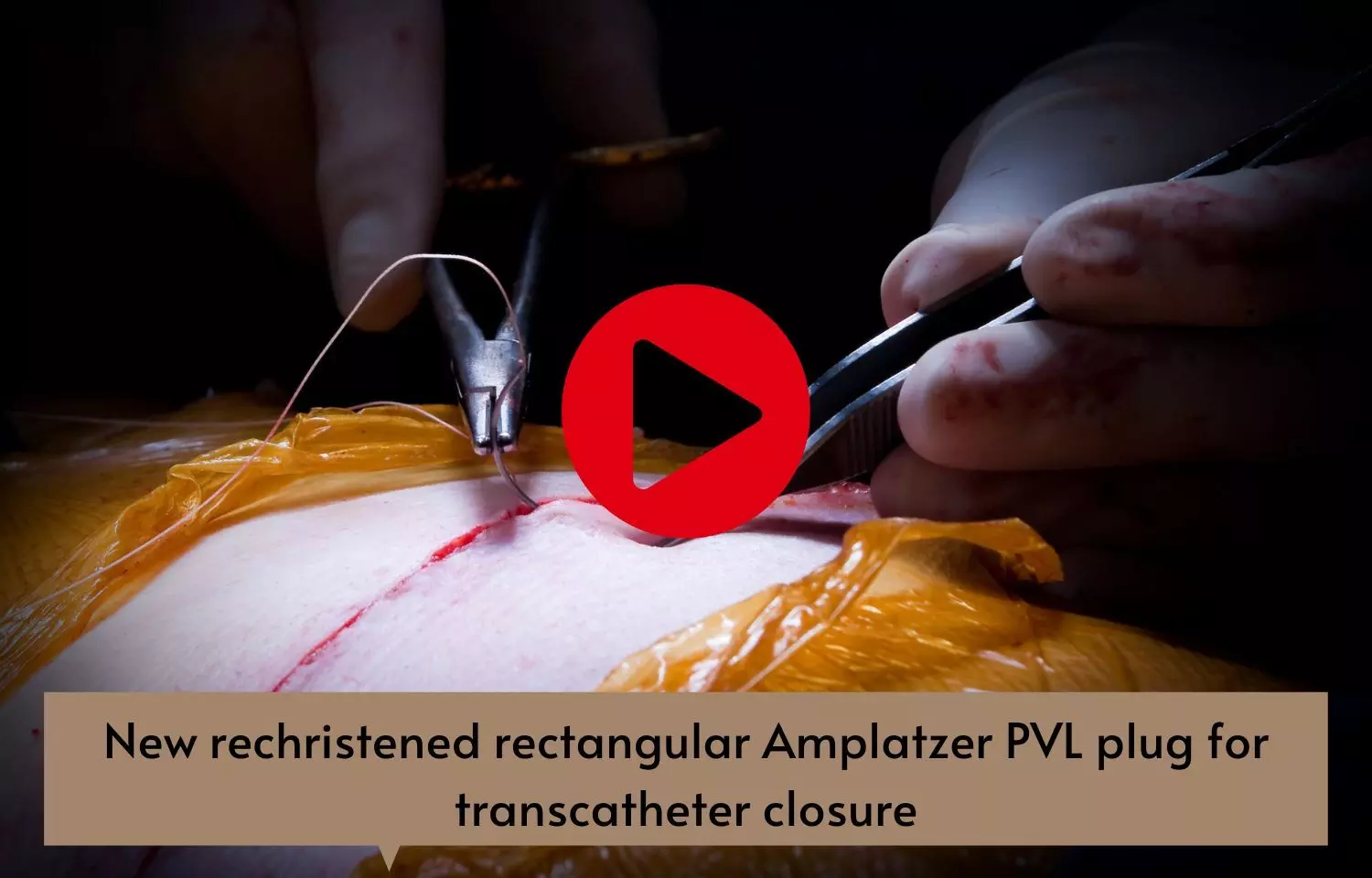 New rechristened rectangular Amplatzer PVL plug for transcatheter closure