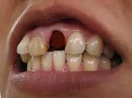 Oral antibiotics not beneficial for  replantation of avulsed teeth: study