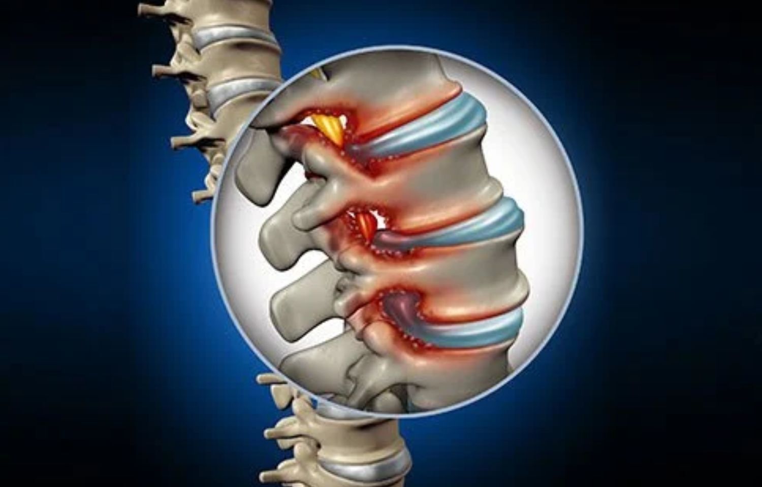 Spine Discs