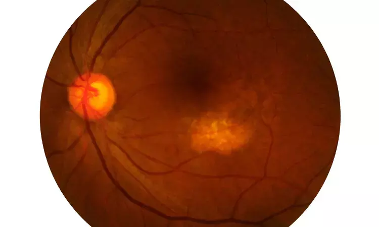 High-tech imaging reveals details about rare eye disorder