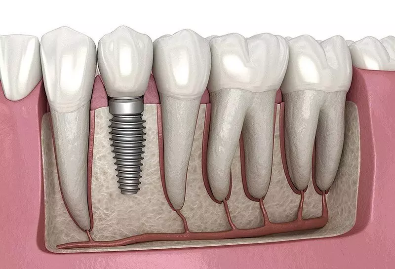 One-piece dental implants induce lower stress values compared to two-piece dental implants : study