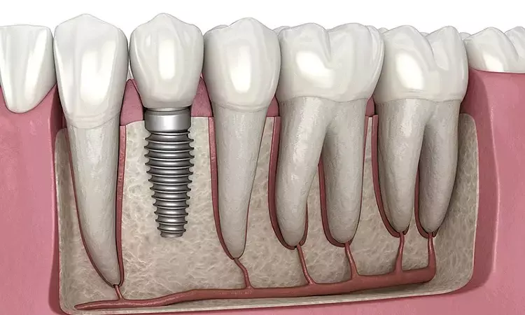 One-piece dental implants induce lower stress values compared to two-piece dental implants : study