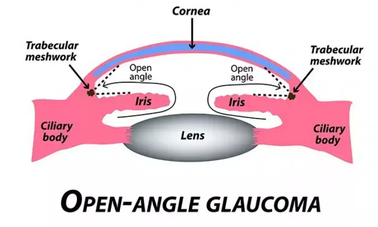 Myopic Refractive Error tied with increased Primary Open-Angle Glaucoma risk: study