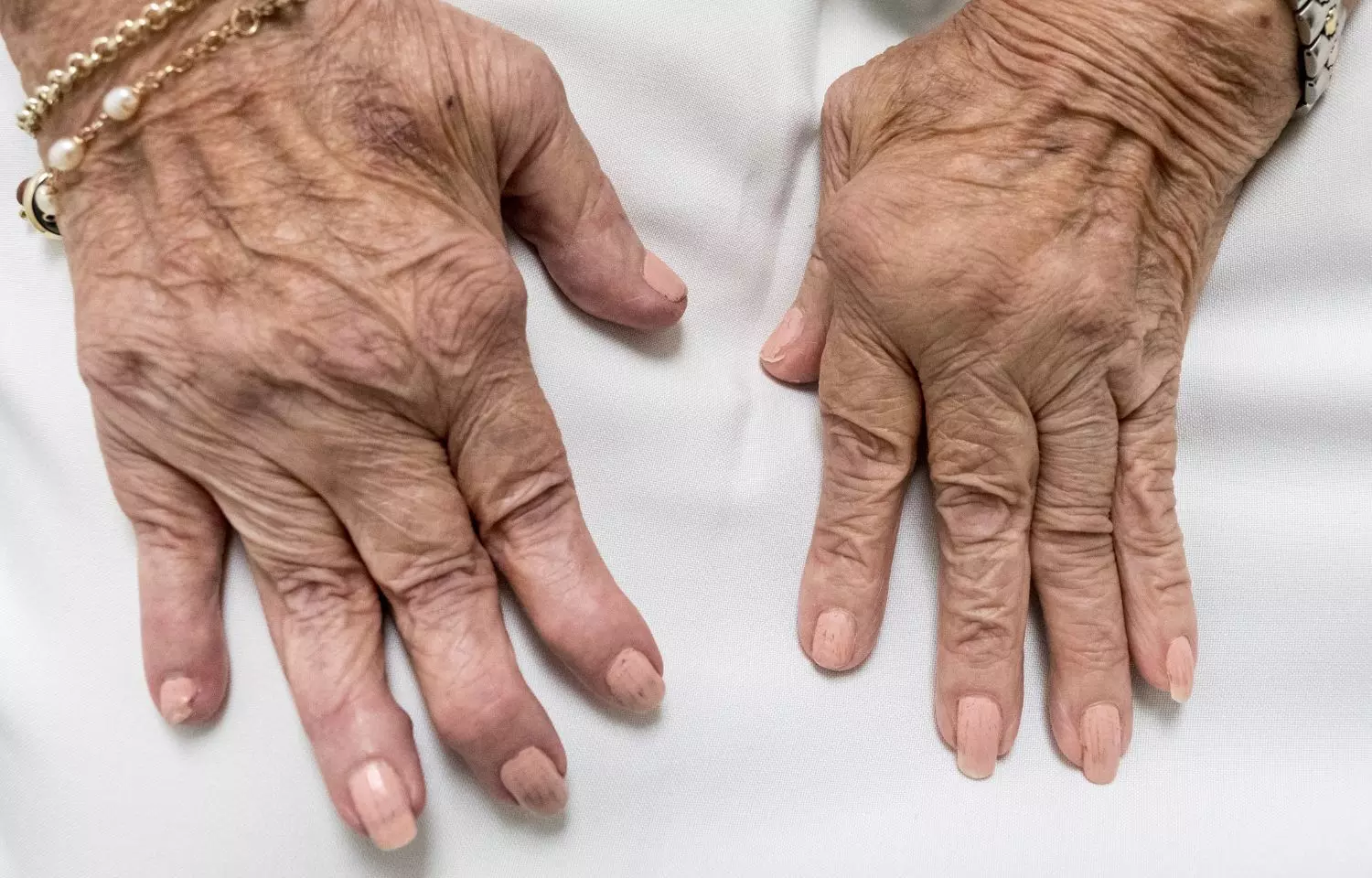 Rheumatoid arthritis