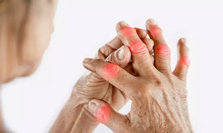 Flare up of gout linked to increased risk MI and stroke: JAMA