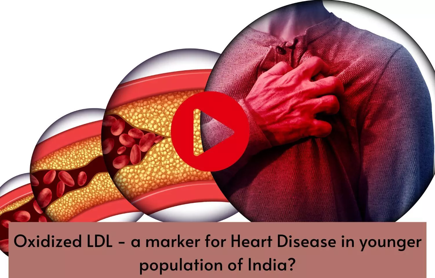 Oxidized LDL - a marker for Heart Disease in younger population of India?