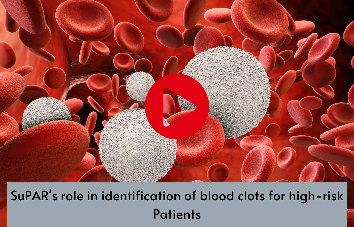 SuPARs role in identification of blood clots for high-risk Patients