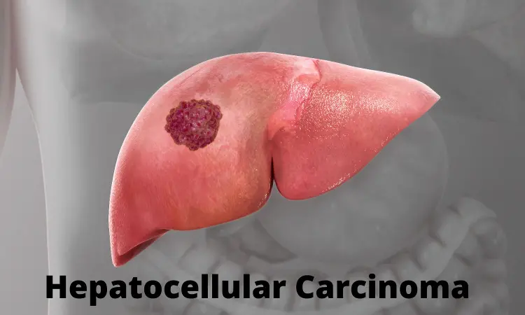 Repeat hepatic resection and ablation tied to similar overall survival in recurrent hepatocellular carcinoma: Study