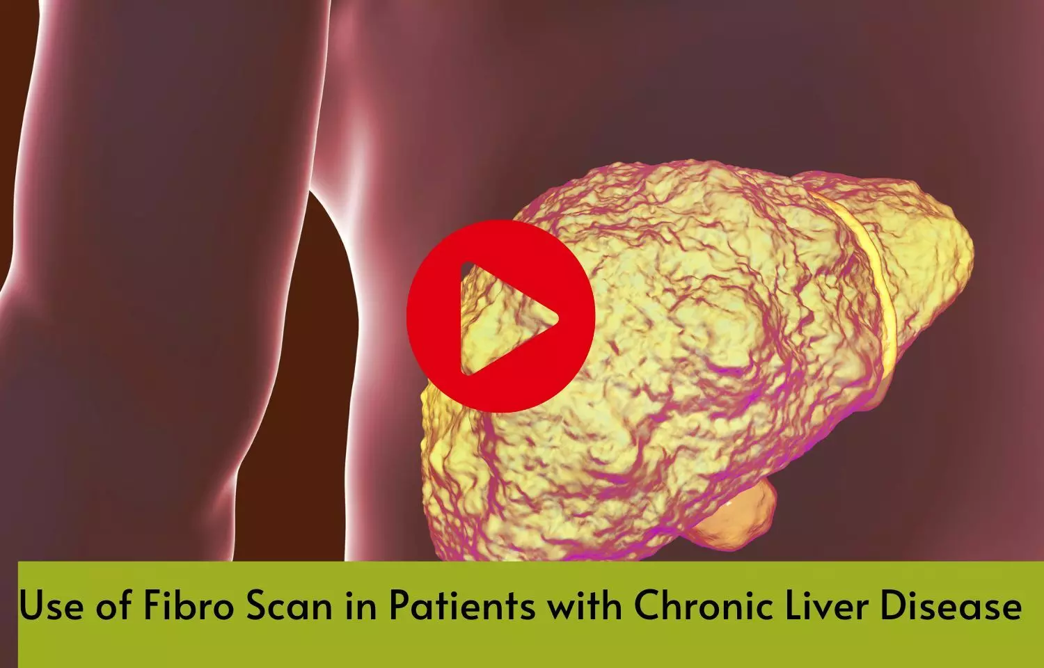Use of Fibro Scan in Patients with Chronic Liver Disease