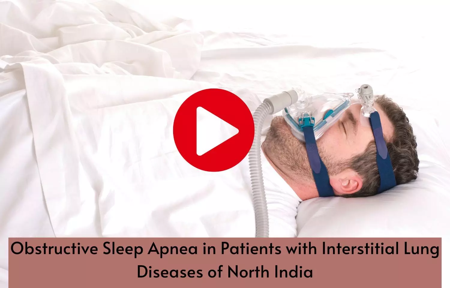 Obstructive Sleep Apnea in Patients with Interstitial Lung Diseases of North India