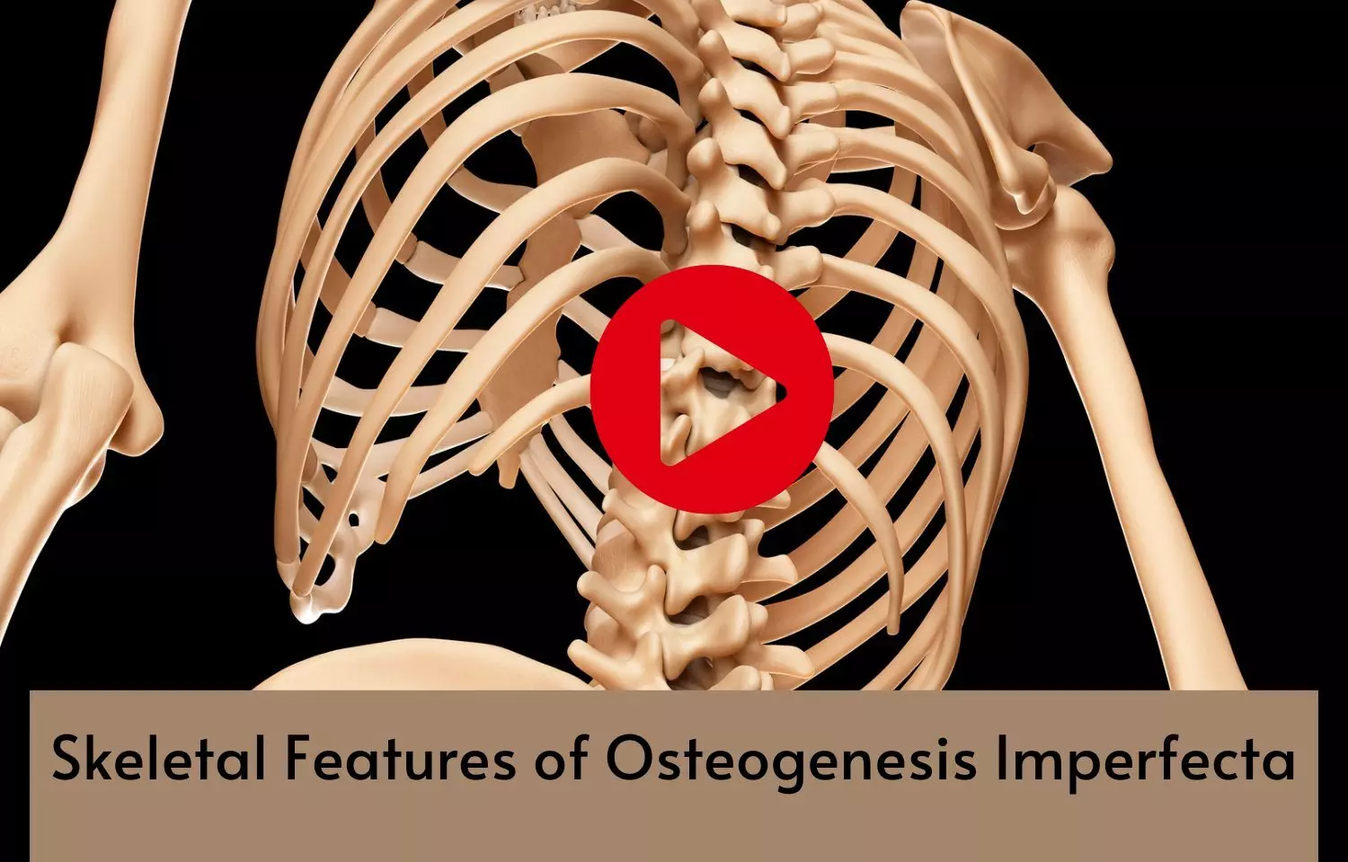 Skeletal Features of Osteogenesis Imperfecta