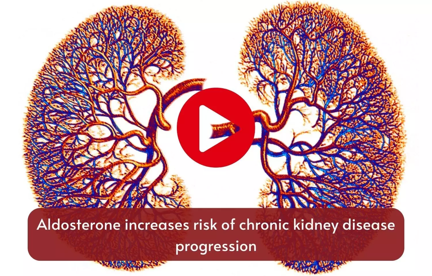 Aldosterone increases risk of chronic kidney disease progression