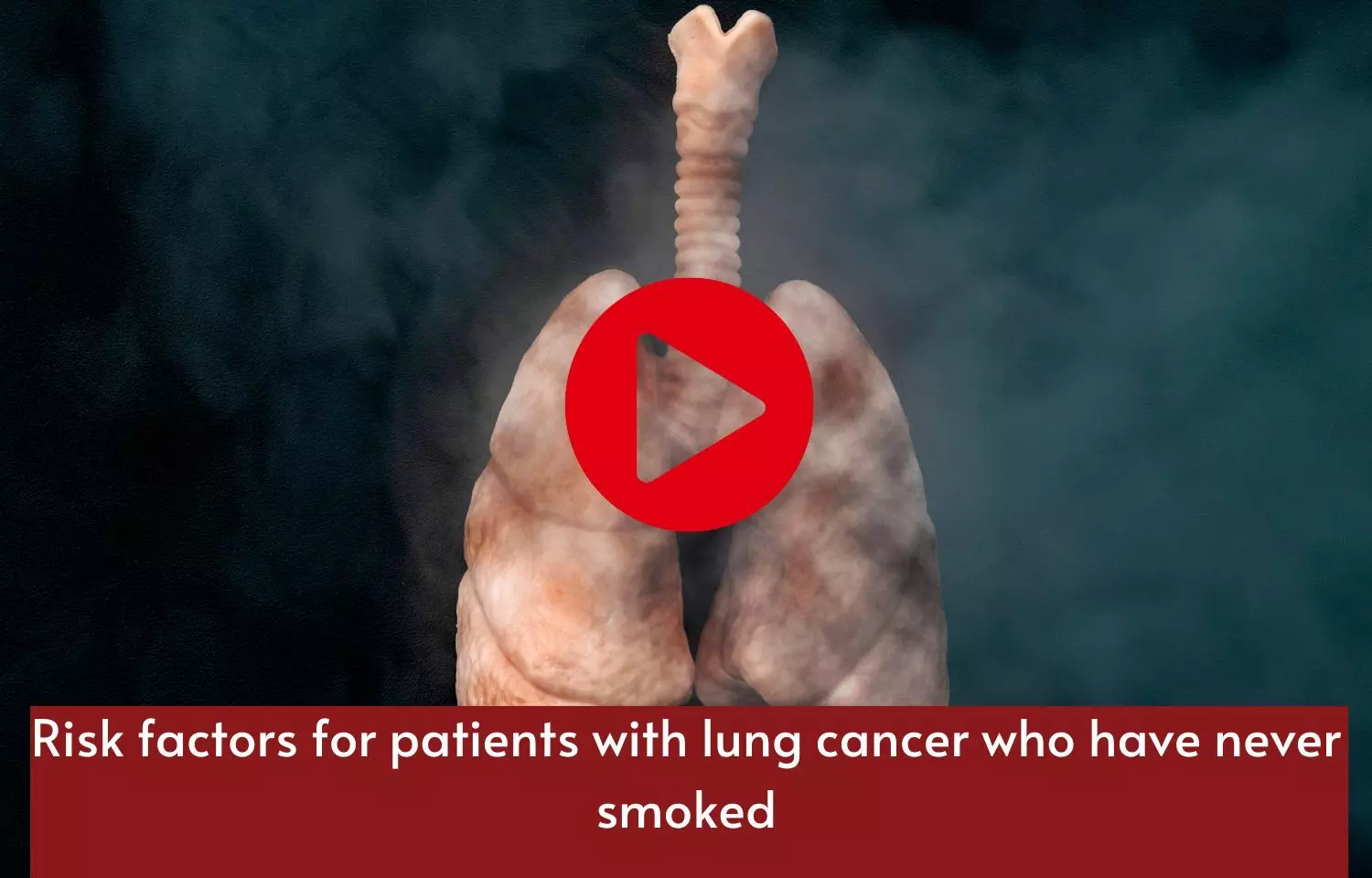 Risk factors for patients with lung cancer who have never smoked