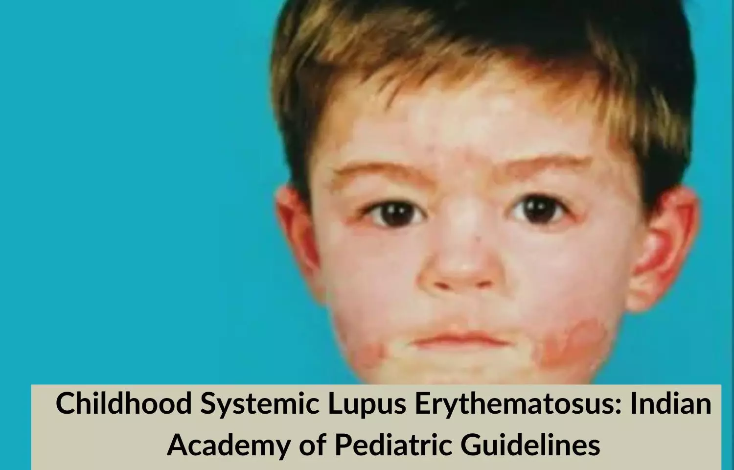 Childhood Systemic Lupus Erythematosus: IAP Guidelines