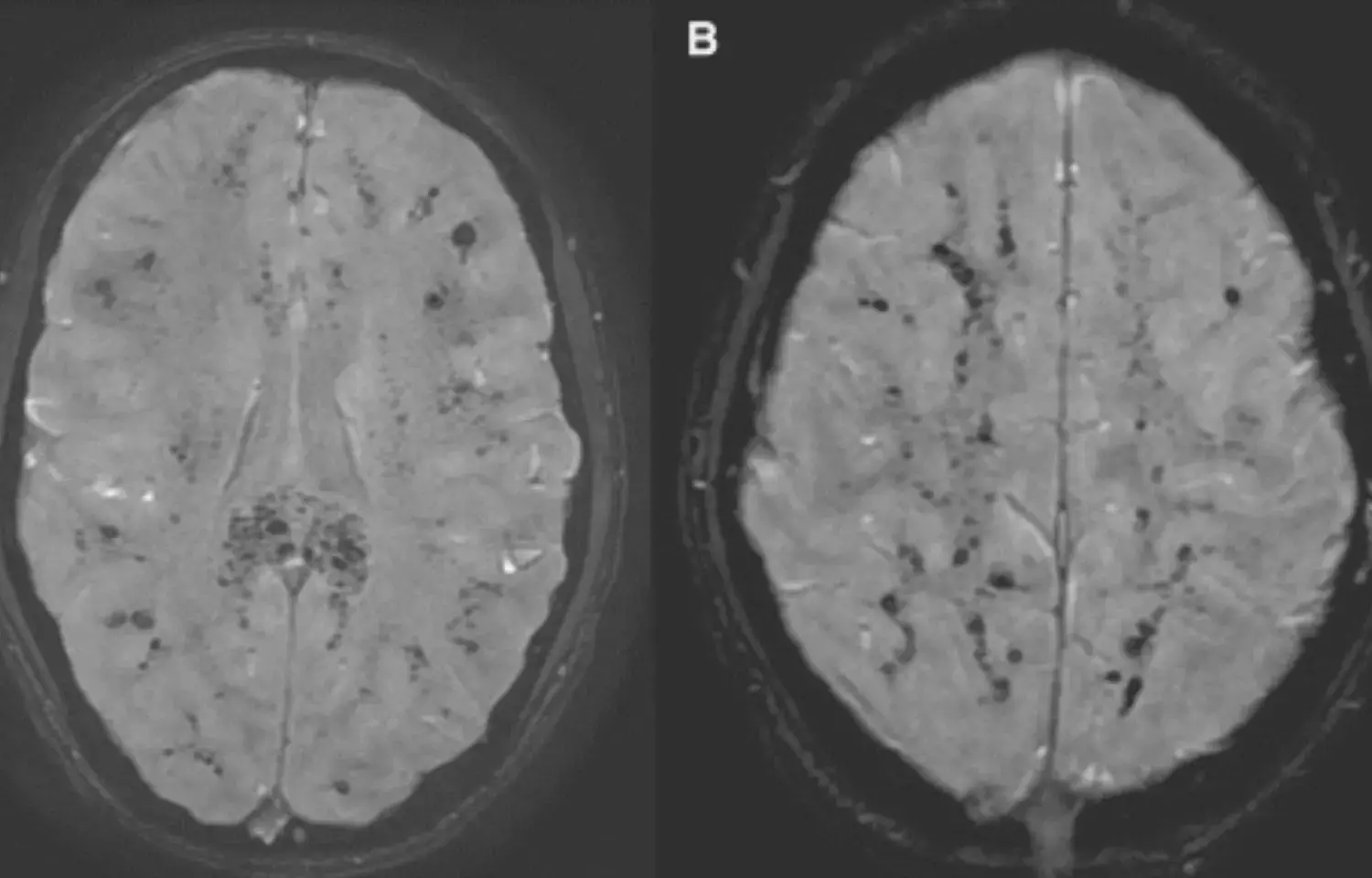 New cerebral microbleeds observed on MRI post-TAVR: Circulation