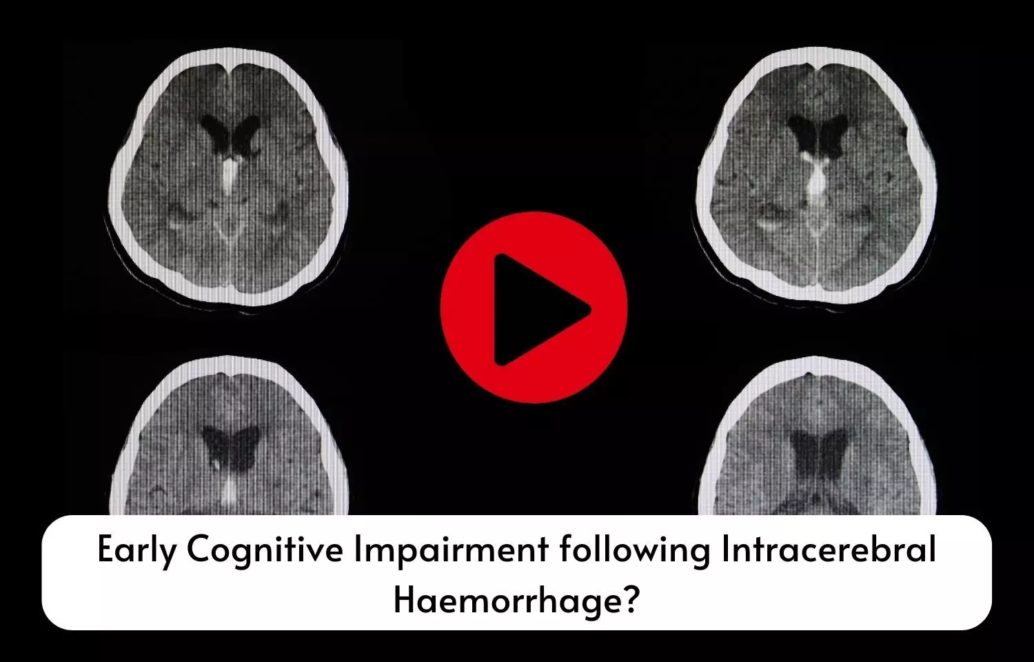Early Cognitive Impairment following Intracerebral Haemorrhage?