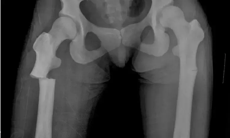 Rare case of bilateral atypical subtrochanteric Femoral Fractures in pycnodysostosis patient- a report