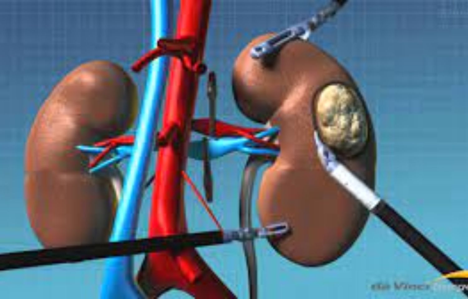 robotic-ivc-thrombectomy-not-inferior-to-standard-open-ivc-thrombectomy