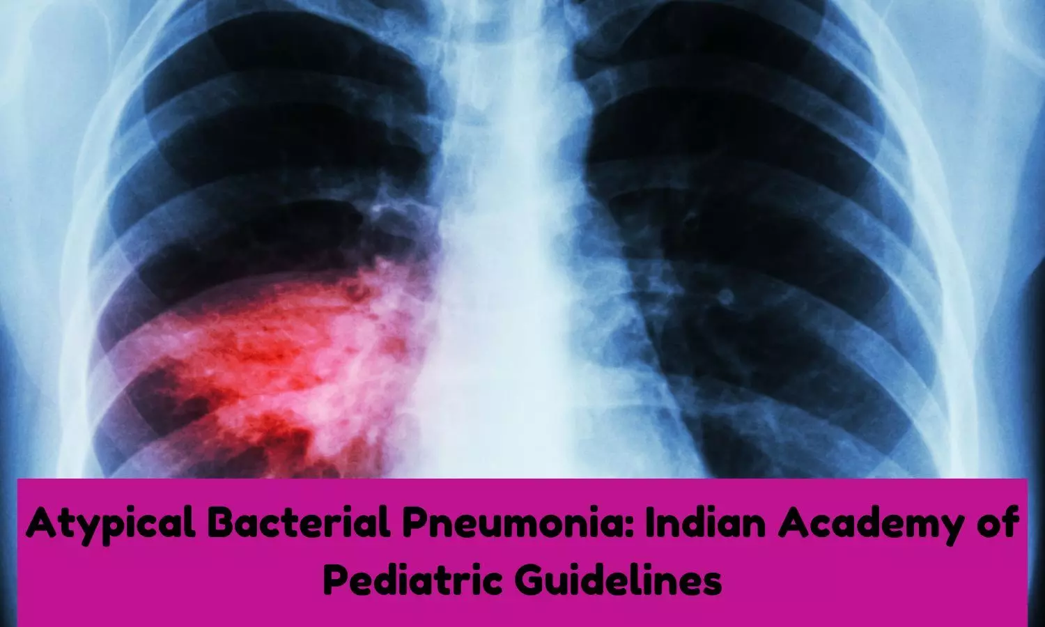 Atypical Bacterial Pneumonia in Children: IAP Guidelines