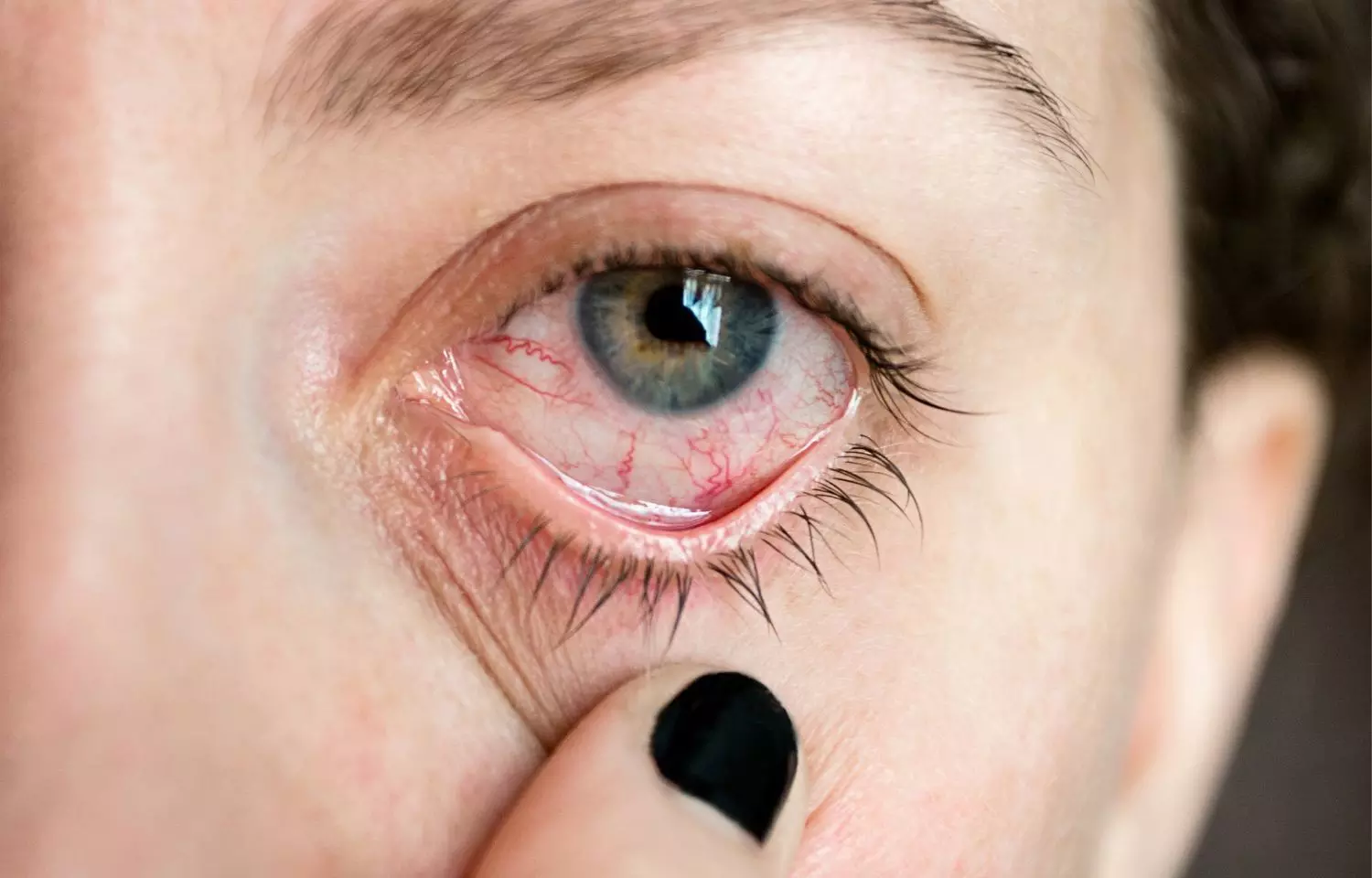 Non-segmental vitiligo closely related to ocular problems: Study