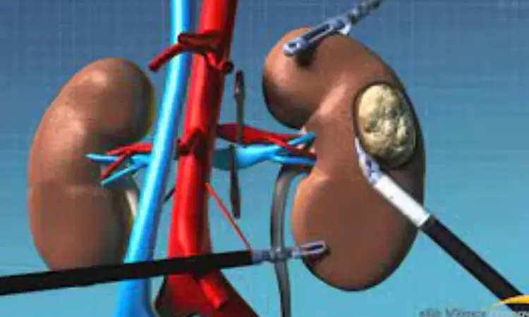 Robotic IVC thrombectomy not inferior to standard open IVC thrombectomy for kidney cancer