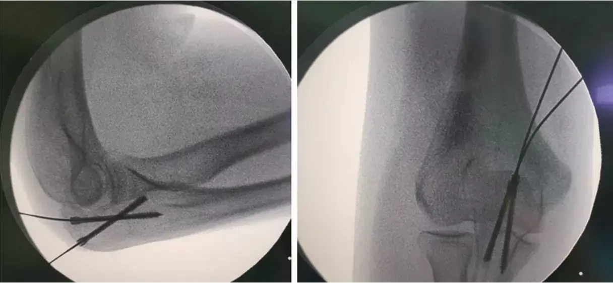 Herbert screw fixation may safely treat isolated olecranon fractures in children