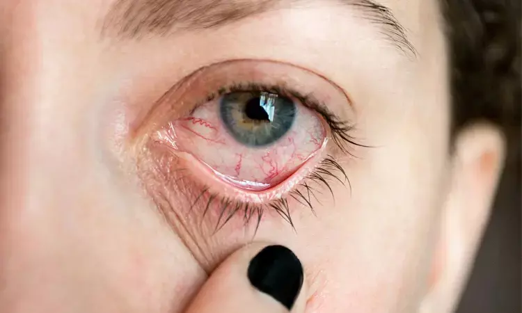 Study finds cyclosporine A gel effective against dry eye disease