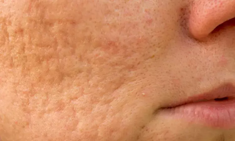 Microneedling better than chemical peels for treatment of acne scar