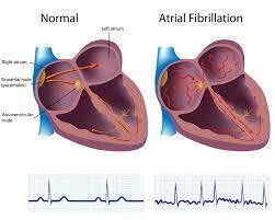 DR‐FLASH Score Is Useful for Identifying Patients With Persistent Atrial  Fibrillation Who Require Extensive Catheter Ablation Procedures